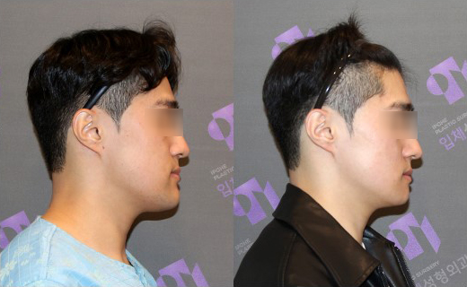 주걱턱 교정은 어떤 수술이 좋을까요? 턱끝후진술의 한계와 실제 결과 관련 이미지 4