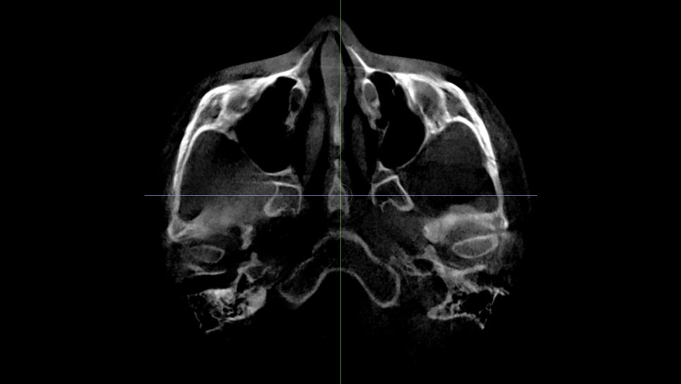 Back Cheekbone Shaving? Osteotomy? Do You Really Need It? image 6