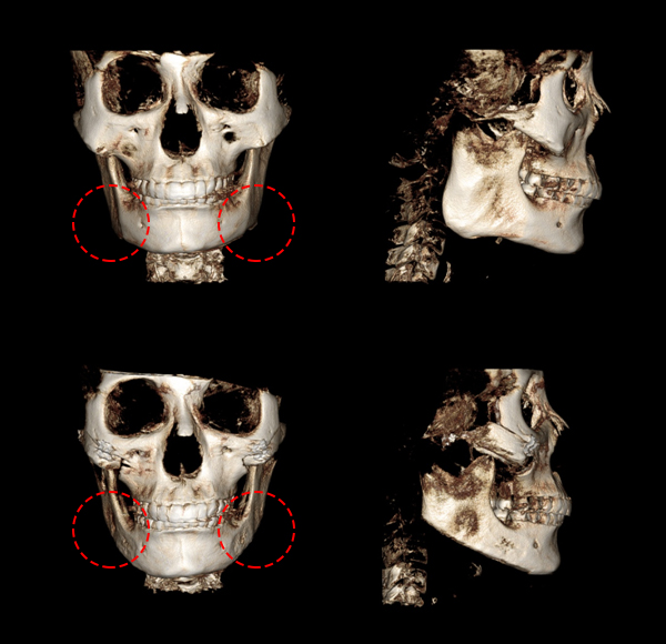 V-Line Square Jaw Surgery Is Good for the Front View Effect image 11