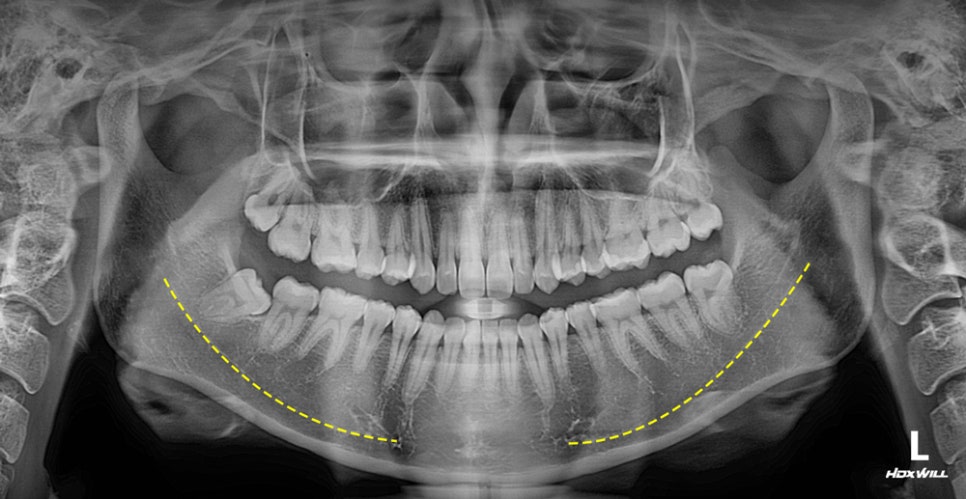 Does a Low Nerve Canal Make Square Jaw Surgery Difficult? Ways to Improve Frontal Results image 3