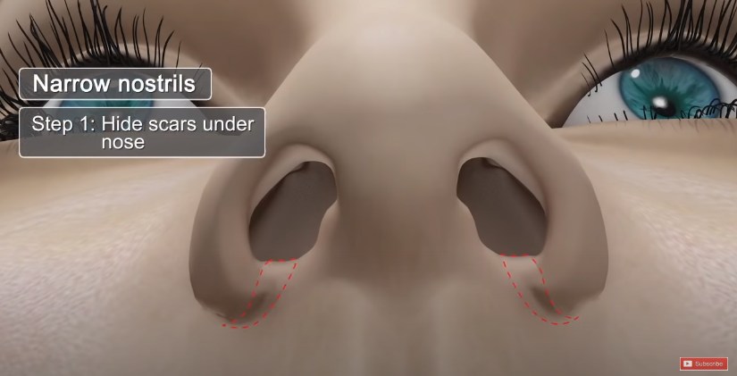 Is There a Nose Alar Reduction Surgery Without Scarring? (Looking at Before-and-After Photos) image 2