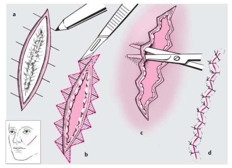 Key Techniques in Forehead Reduction Surgery - Trichophytic and W-Plasty Incisions image 4