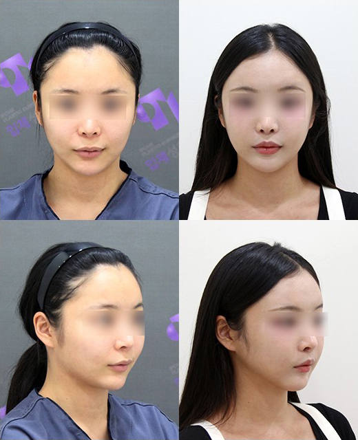 원장님, 윤곽수술하면 예뻐지는 게 맞나요? 관련 이미지 8