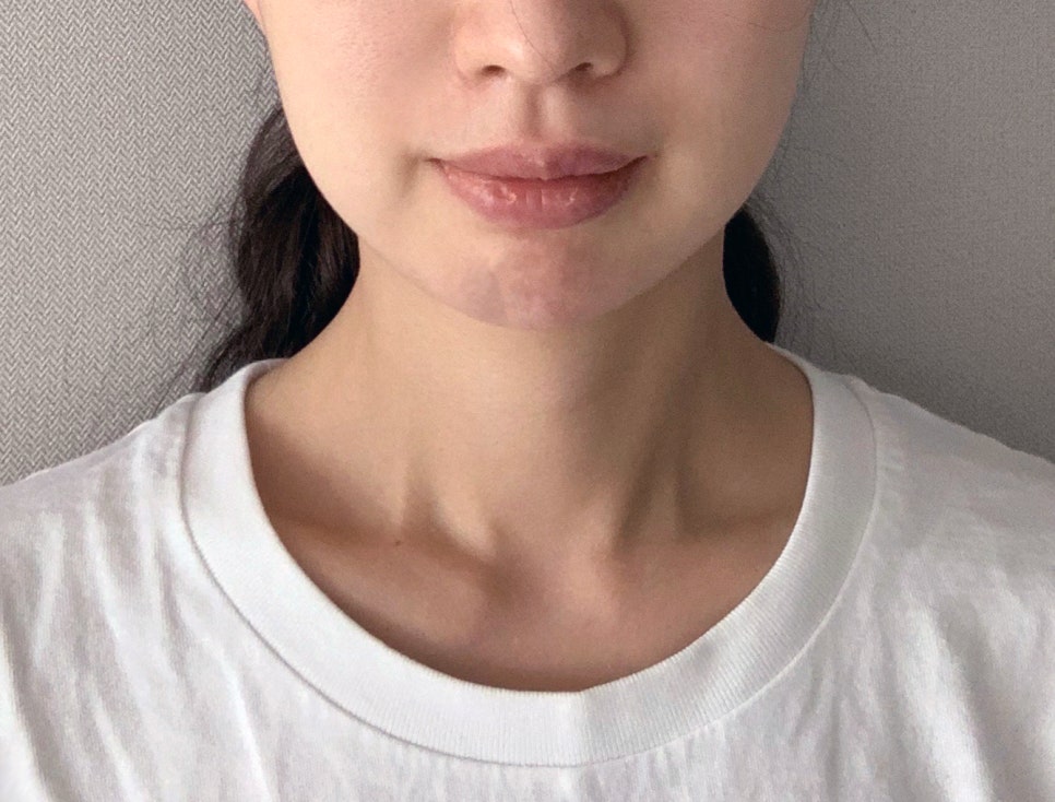 What Side Effects Can Occur After Chin Surgery? image 4