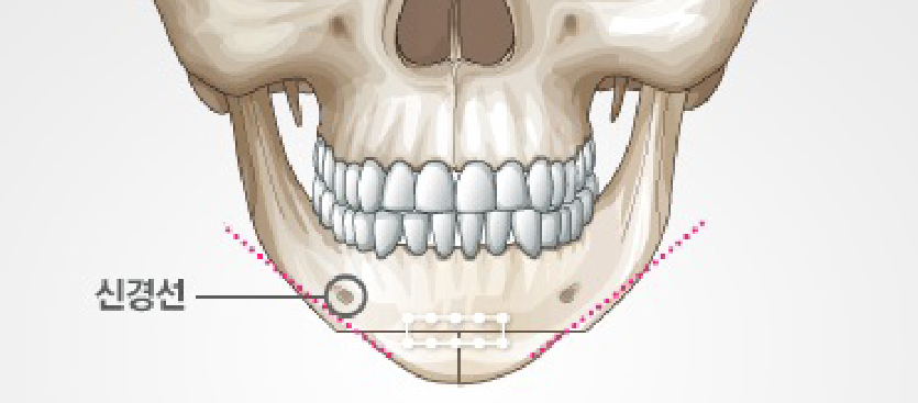 Is T-Osteotomy Better for Chin Surgery? - Explained by a Specialist image 3