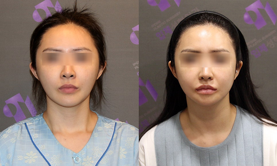 안면윤곽, 많이 가져오는 연예인 사진은? 관련 이미지 5