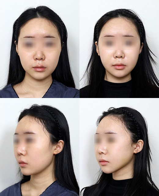 사각턱 유형에 따라 수술 효과가 달라진다? 말린 턱과 뻗친 턱의 차이 관련 이미지 9