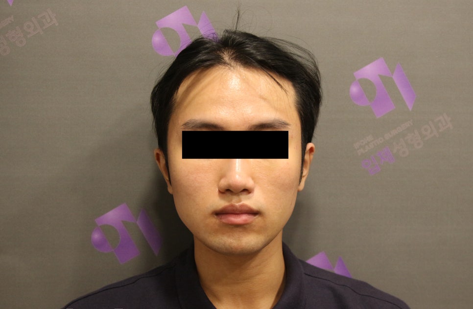 남자사각턱, 남자다운 턱선이 중요한 안면윤곽수술 관련 이미지 3