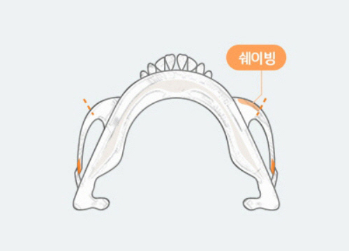 광대축소술 과교정 되돌릴 수 있나요? 관련 이미지 5