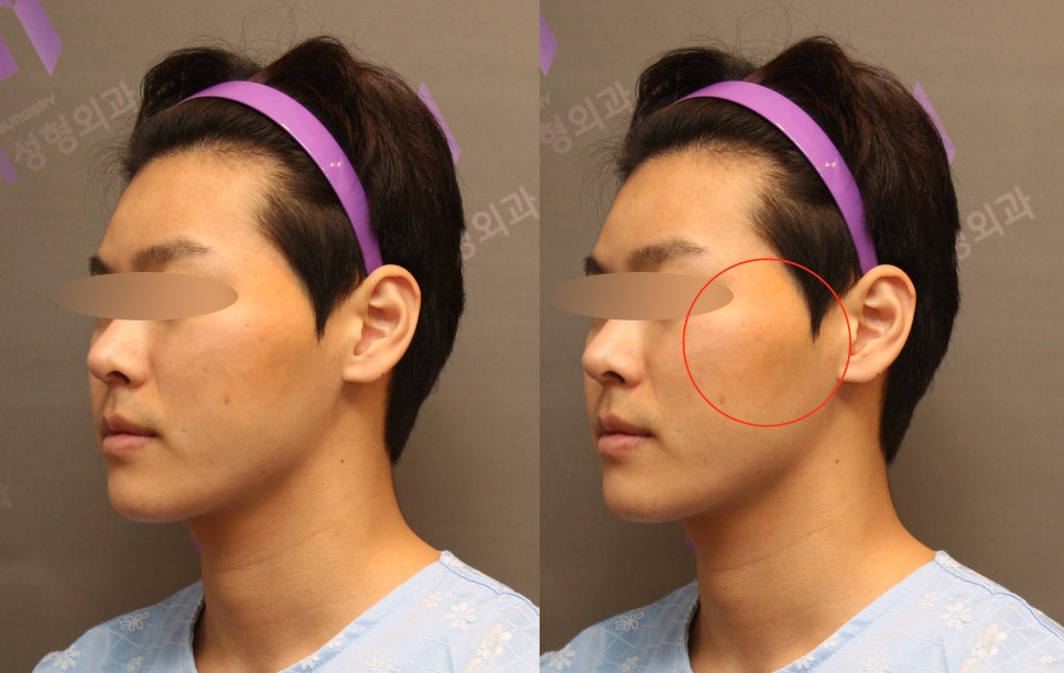 Male Cheekbone Reduction Surgery, Explained with Before-and-After Photos of Facial Contouring Surgery. image 2