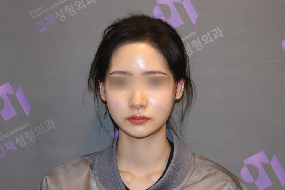 Side Effects of V-Line Square Jaw Surgery, Common Traits of People Who Experience Failed Results image 3