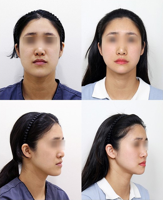 Long Midface and Lower Face Long-Face, Long-Chin Surgery - Cases That Do Not Require Double-Jaw Surgery image 8
