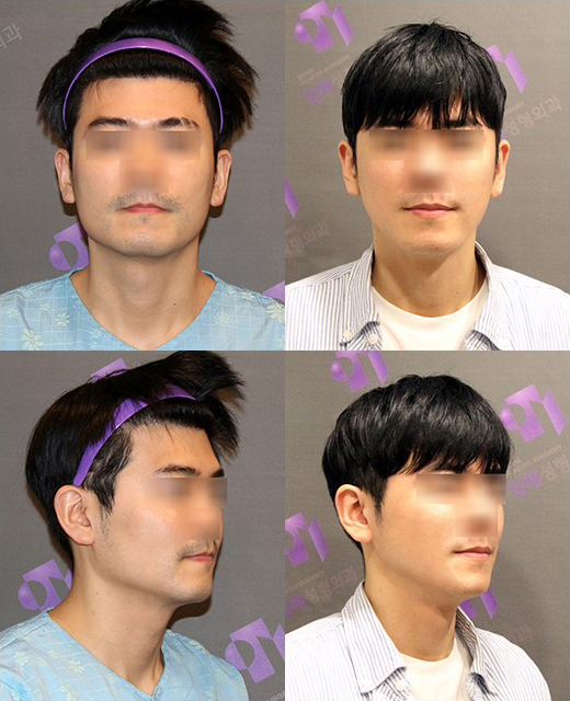T-Genioplasty Techniques That Vary Depending on the Shape of the Chin image 12