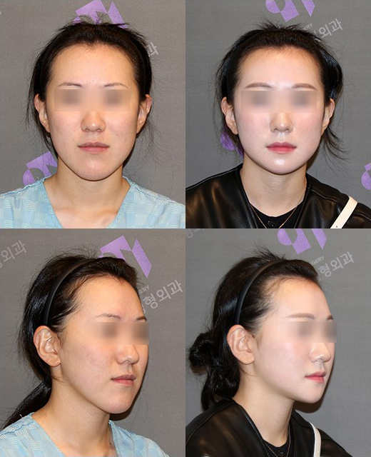 Which Surgery Do I Need: Contouring Surgery or Double-Jaw Surgery? image 23