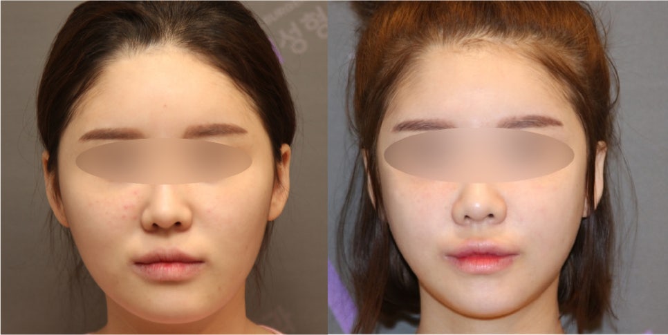 안면윤곽, 연예인 신세경처럼 예뻐질수 있을까요? -전문의가 알려드립니다. 관련 이미지 4