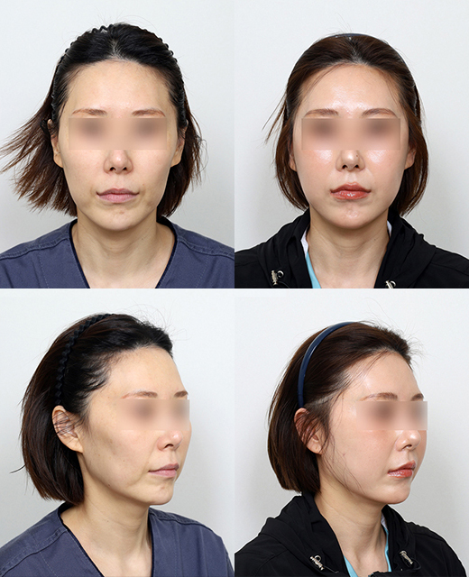 Zygoma Reduction Surgery: Effects and Differences Between 230-Degree and 3D Zygoma Reduction image 6