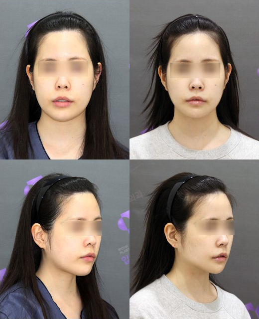 Facial Contouring A to Z: What Is Contouring Surgery? image 15
