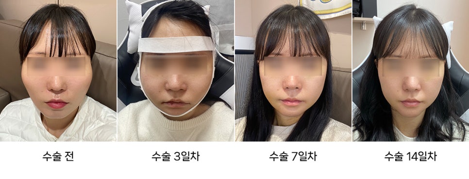 The Difference Between Swelling and Cheek Sagging After Facial Contouring Surgery image 3