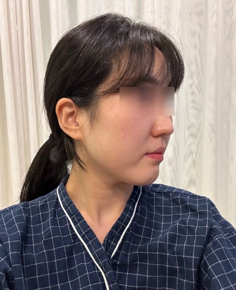 How Long Do Facial Contour Changes Continue After Facial Bone Contouring Surgery? (Day 1 to Day 365) — See With Photos image 2