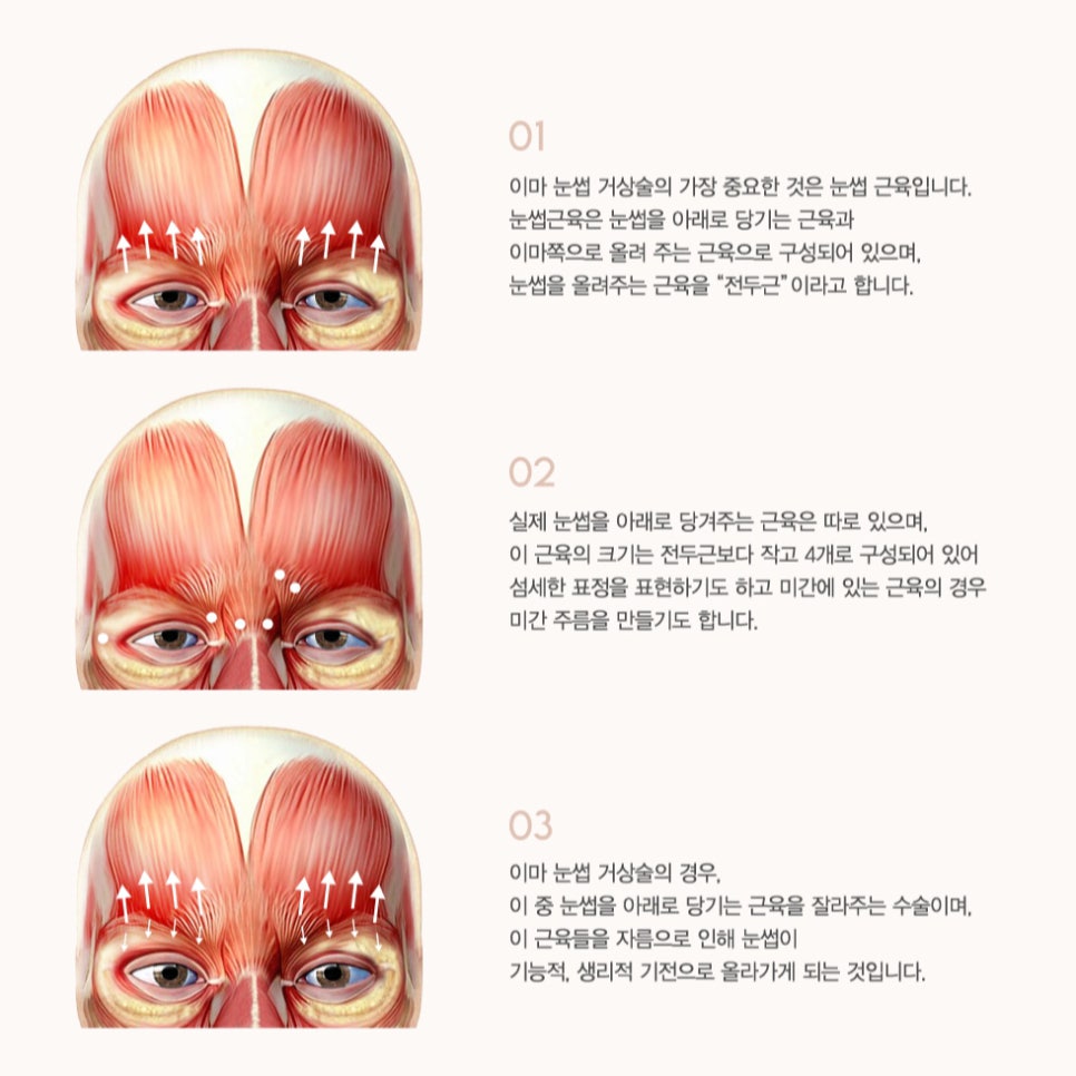 눈썹하거상술 vs 이마거상술 차이와 선택 방법 관련 이미지 3