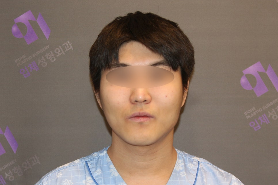 Male Cheekbone Reduction Surgery: Looking at Real Cases of Facial Contouring Surgery image 1