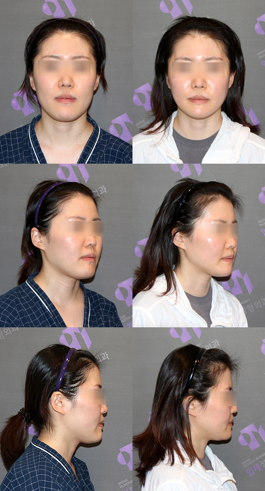 Let's Take a Close Look at Double Chin Removal and Double Chin Muscle Tightening. image 1