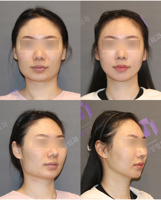 Facial Contouring Surgery image 6