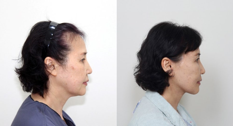 The Importance of Buccal Fat Removal in Facelift Surgery image 7