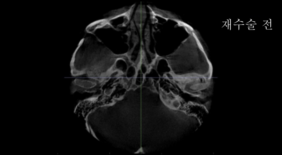 A Complete Summary of 6 Complications After Cheekbone Surgery: Sinusitis, Recurrence, Hollow Cheeks, and Sagging Cheeks image 6