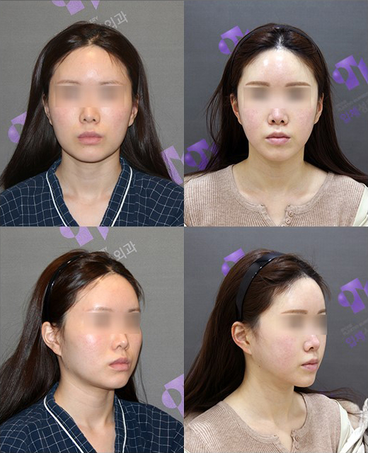 What Are Contouring 3, 4, and 5 Procedures, and Which Surgery Should I Have? image 4
