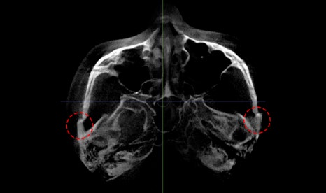After cheekbone reduction surgery, is there still a back cheekbone left? Is there a solution? image 2
