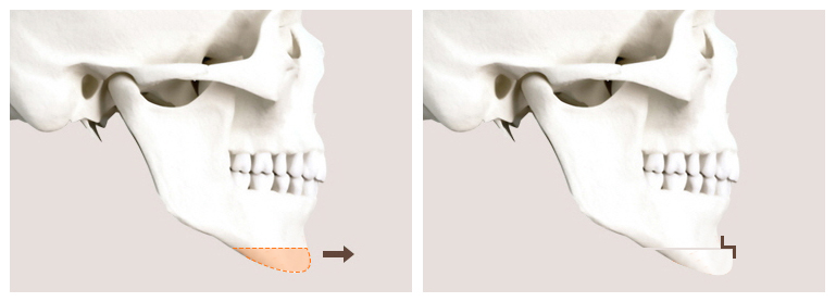 Can Chin Advancement Surgery Adjust Chin Length? image 1