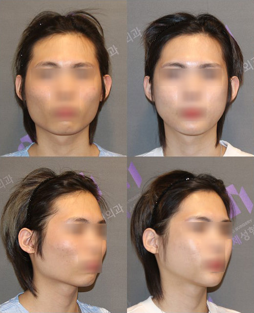 남자사각턱수술이 여자와 다른 이유는? 관련 이미지 3