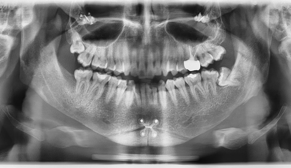 After Facial Contouring Surgery: Asymmetry, When Can Revision Surgery Be Performed? image 12