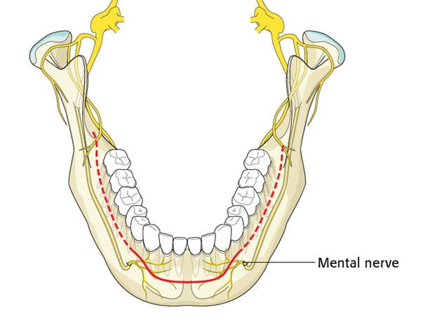 What uncomfortable symptoms can occur after chin surgery? image 2