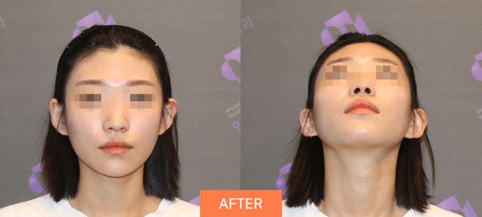 Lateral Cheekbone Reduction, 230-Degree Three-Dimensional Cheekbone Reduction from the Front to the Side image 4