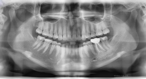 [Chin Surgery] Learning About Contouring Shaving and T-Osteotomy with Real Patient Cases (3) image 6