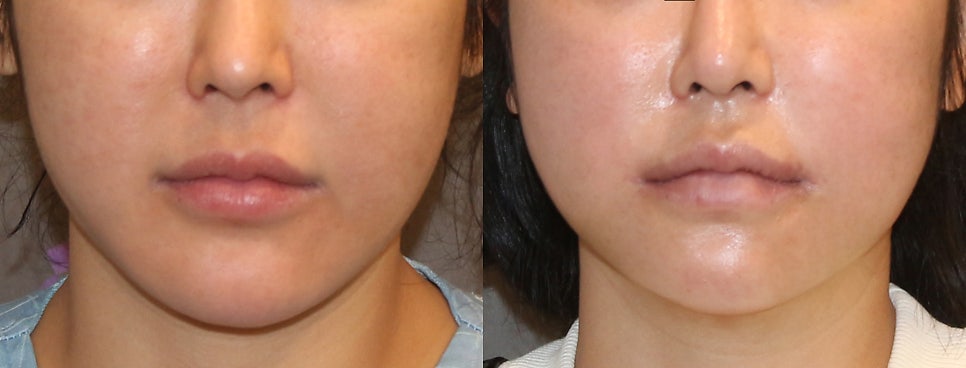 How to Adjust Long-Face Proportions: Philtrum Reduction Surgery image 4