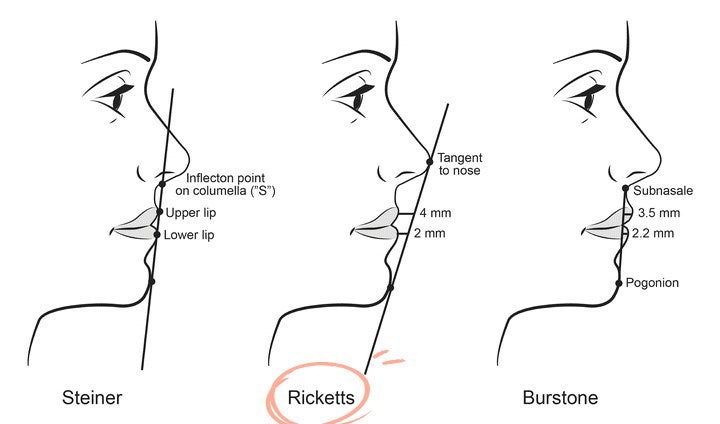 What Surgery Is Best for Correcting a Recessed Chin? The Limits of Chin Advancement Surgery and the Actual Results image 1