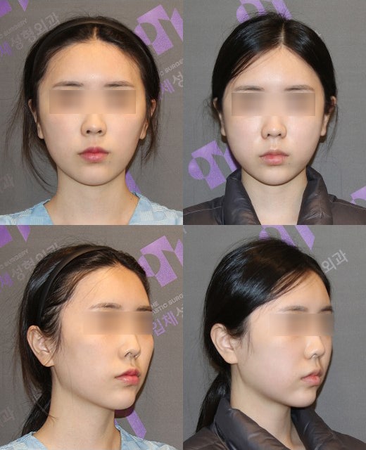 Zygoma Reduction Surgery: the Effectiveness and Selection Criteria of 230-Degree Zygoma vs. 3D Zygoma Surgery image 8