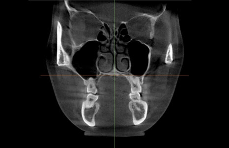 Are There People Who Can’t Have Cortical Ostectomy Surgery for a Frontal Square Jaw Effect? image 1