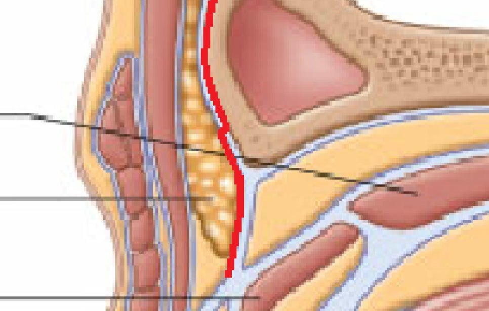 How Far Should Forehead Lift Dissection Go? Is More Fixation Always Better? image 3