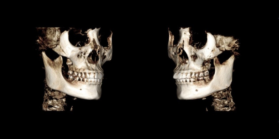 Non-fixation zygoma reduction surgery, will the bone heal properly? image 2