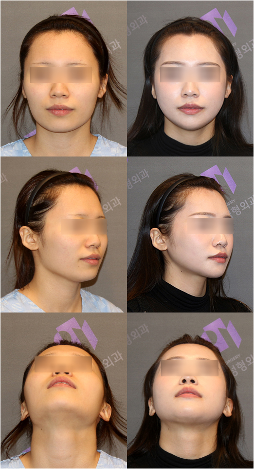 광대축소술, 내 광대뼈는 얼마나 줄어들 수 있나요? 관련 이미지 8