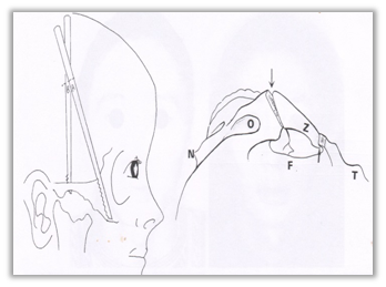 Why Are There So Many Methods for Cheekbone Surgery? A Look at Osteotomy Methods image 3