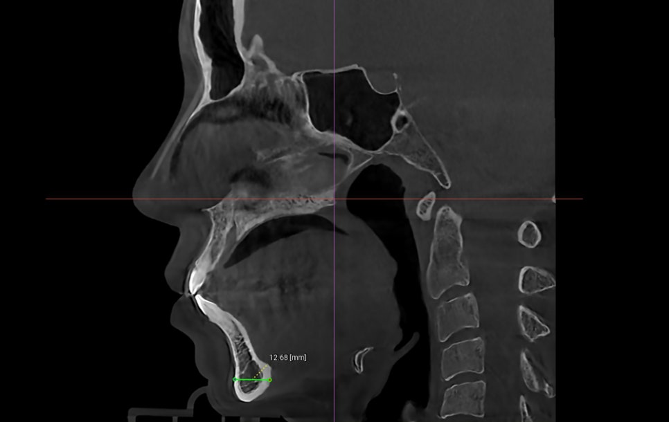 What Surgery Is Best for Correcting a Short Chin or Recessed Chin? The Limits of Chin Surgery and the Actual Results image 8