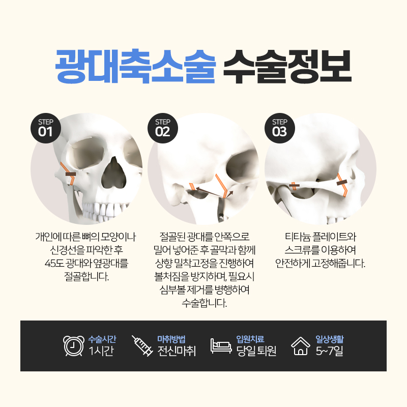 안면윤곽수술, 처음부터 끝까지 A to Z 관련 이미지 6