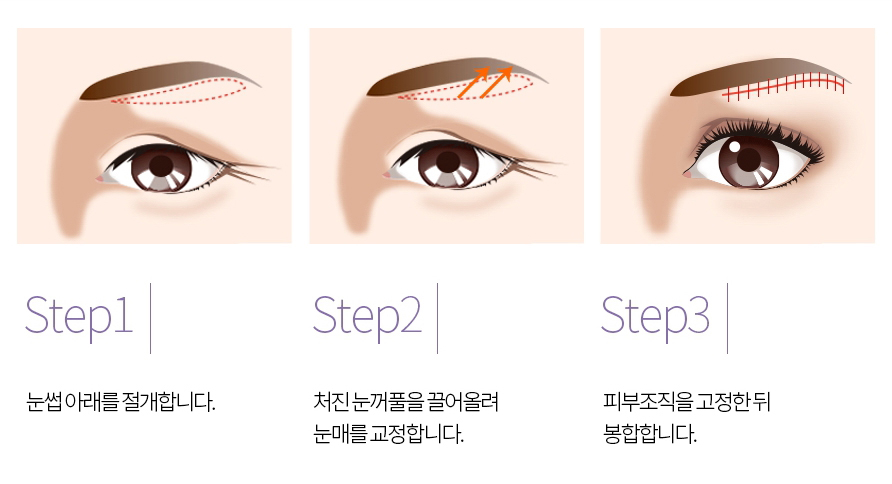 눈썹하거상술 vs 이마거상술 차이와 선택 방법 관련 이미지 5