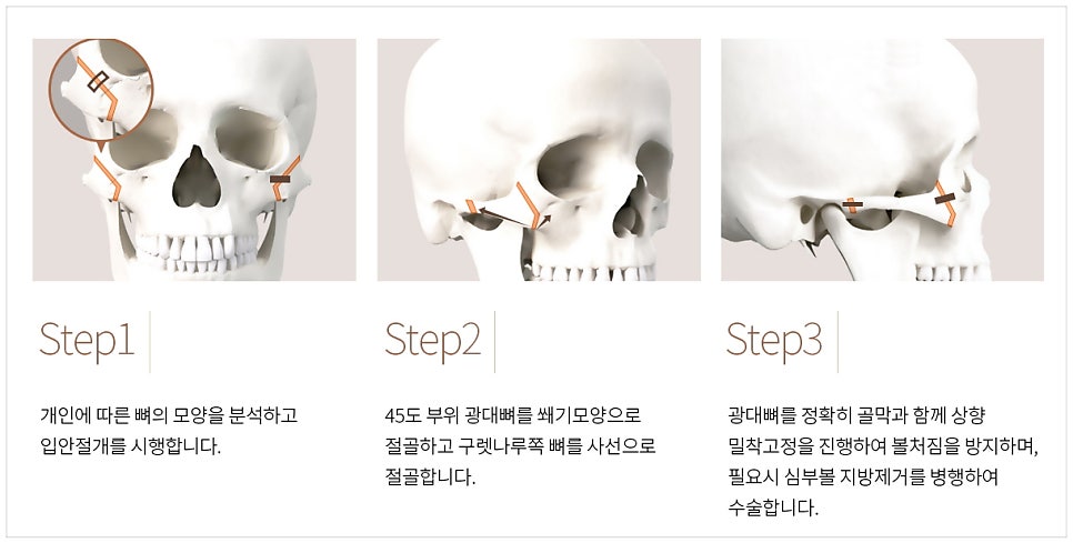 Is facial contouring surgery possible even at an older age? Important things you should know image 8