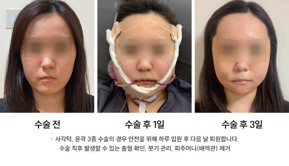 When Is Hospitalization Needed After Contouring Surgery? Warning Signs You Must Check image 2
